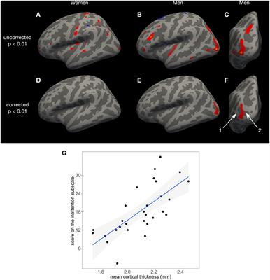 Inattention Predicts Increased Thickness of Left Occipital Cortex in Men with Attention-Deficit/Hyperactivity Disorder